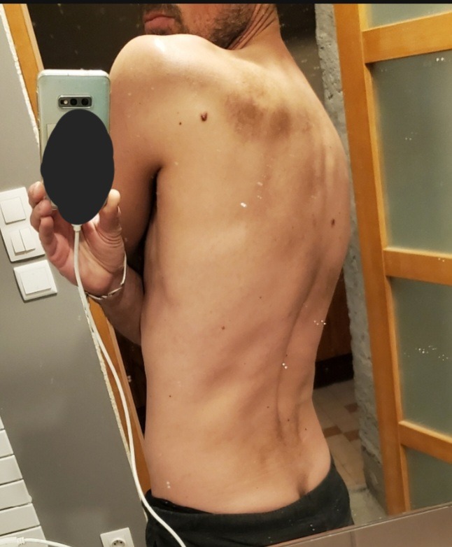 Perfil de Harris